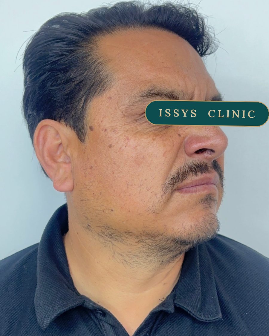 Después del tratamiento: perfil